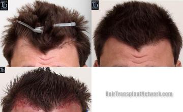 Hair restoration procedure before and after results