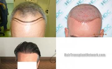 Hair transplantation surgery before and after photos