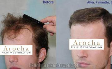 Surgical hair transplantation result photographs