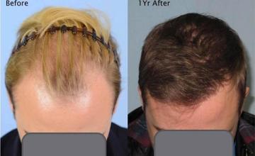 Hair restoration procedure before and after results