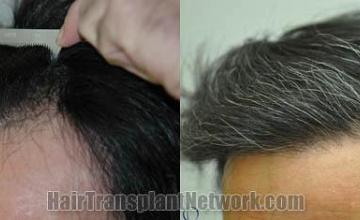 Hair restoration procedure before and after pictures