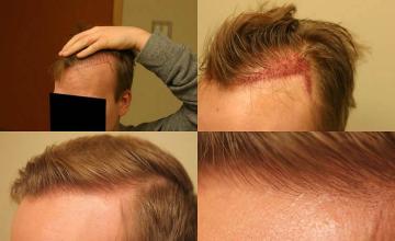 Hair transplantation surgery before and after pictures