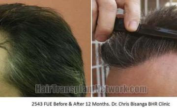 Hair restoration procedure before and after pictures