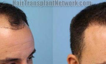 Hair transplantation surgery before and after images