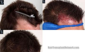 Hair transplantation surgery before and after images