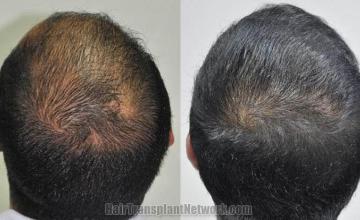 Hair restoration procedure before and after pictures