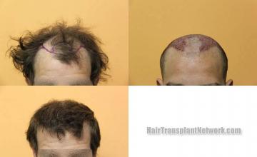 Hair restoration procedure before and after results