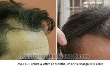 Hair transplantation surgery before and after pictures