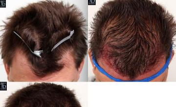 Hair transplantation surgery before and after photos