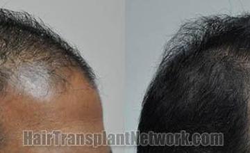 Hair transplantation surgery before and after images