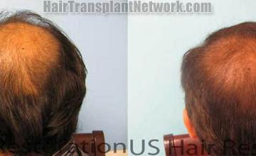 Back view before and after hair transplantation photos