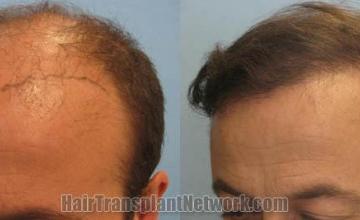 Hair transplantation surgery before and after pictures