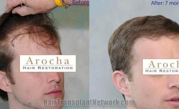 Before and after hair transplantation result photographs