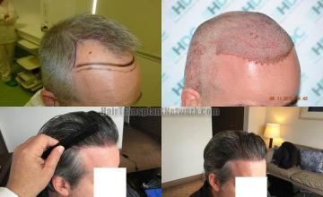 Hair transplantation surgery before and after images