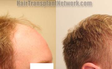 Hair transplantation procedure before and after results