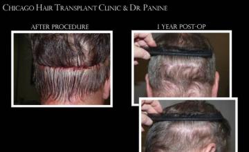 Surgical hair transplantation result photographs