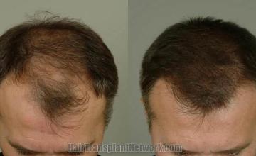 Hair restoration procedure before and after results