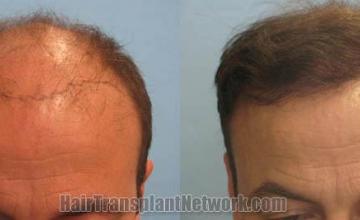 Top view - Before and after surgical hair replacement