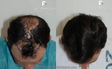 Hair transplantation surgery before and after photos