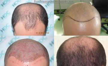 Top view before and after hair restoration results