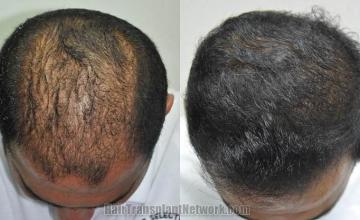 Top view before and after hair restoration results