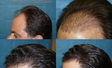 Left view hair transplantation result photographs