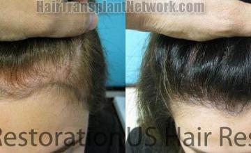 Top view before and after hair restoration results