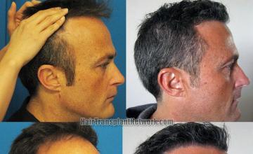 Hair transplantation surgery before and after pictures