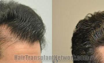 Hair transplantation surgery before and after images