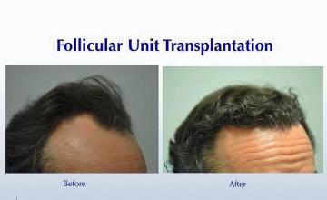 Hair transplant surgery before and after images