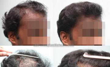 Hair transplantation surgery before and after images