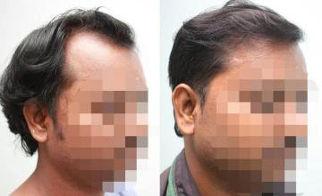 Hair transplantation surgery before and after pictures