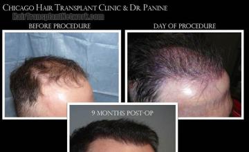 Hair transplantation surgery before and after images