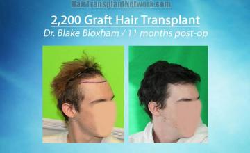 Hair transplantation procedure before and after results