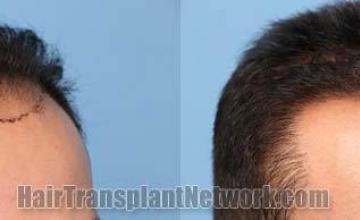 Hair transplantation surgery before and after images