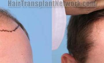 Hair transplantation surgery before and after images