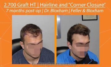 Hair transplantation procedure before and after results