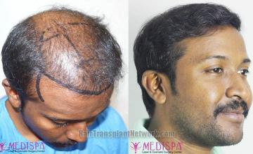 Hair restoration procedure after result images