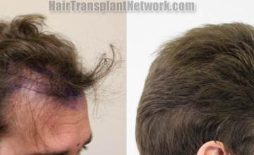 Hair transplantation procedure before and after results