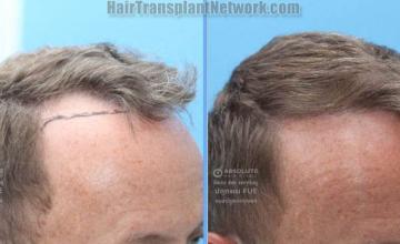 Hair transplantation procedure before and after results