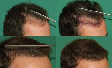 Hair restoration procedure after result images