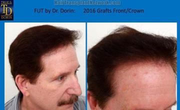 Hair transplant surgery before and after photos