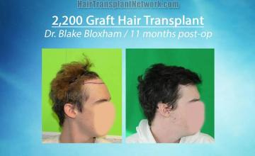 Hair restoration surgery before and after photos