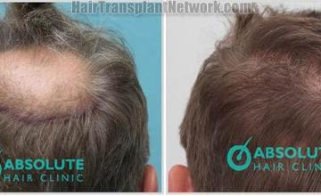 Hair restoration procedure before and after results