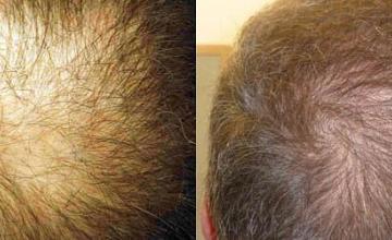 Hair replacement surgery before and after images