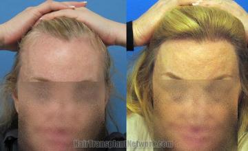 Hair restoration procedure before and after results