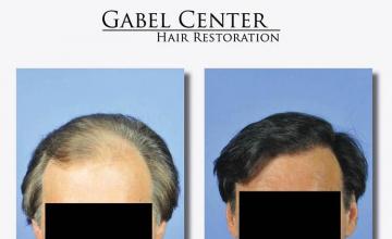 Hair restoration procedure before and after results