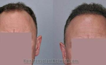 Hair restoration procedure before and after results