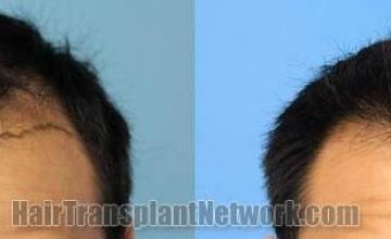 Hair restoration procedure before and after results