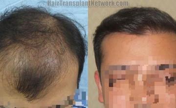 Hair transplantation surgery before and after images